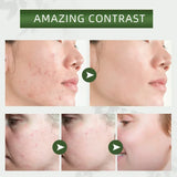 Máscara de Argila e Chá Verde contra Cravos e Acne