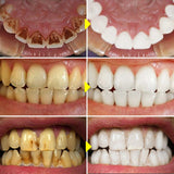 Essência de Clareamento Dental